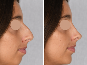 Foto de antes e depois de paciente não identificada após realizar perfiloplastia pelo médico Henry Delmar