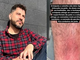 Jornalista Evaristo Costa e imagem de sua perna que ele divulgou nas redes sociais ao falar de erisipela e celulite
