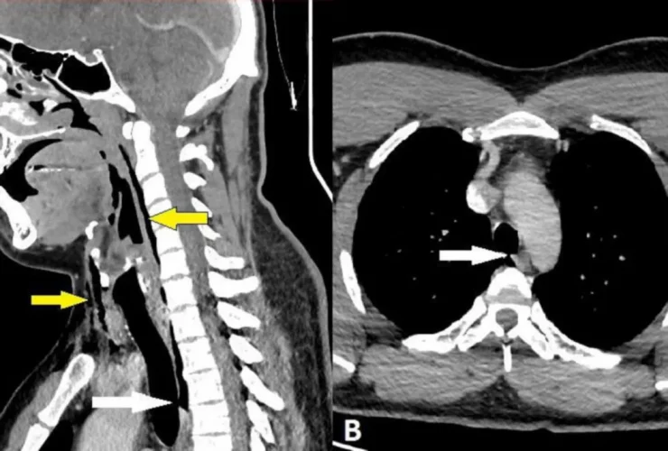 Ressonância magnética do paciente que teve a traqueia perfurada ao segurar um espirro