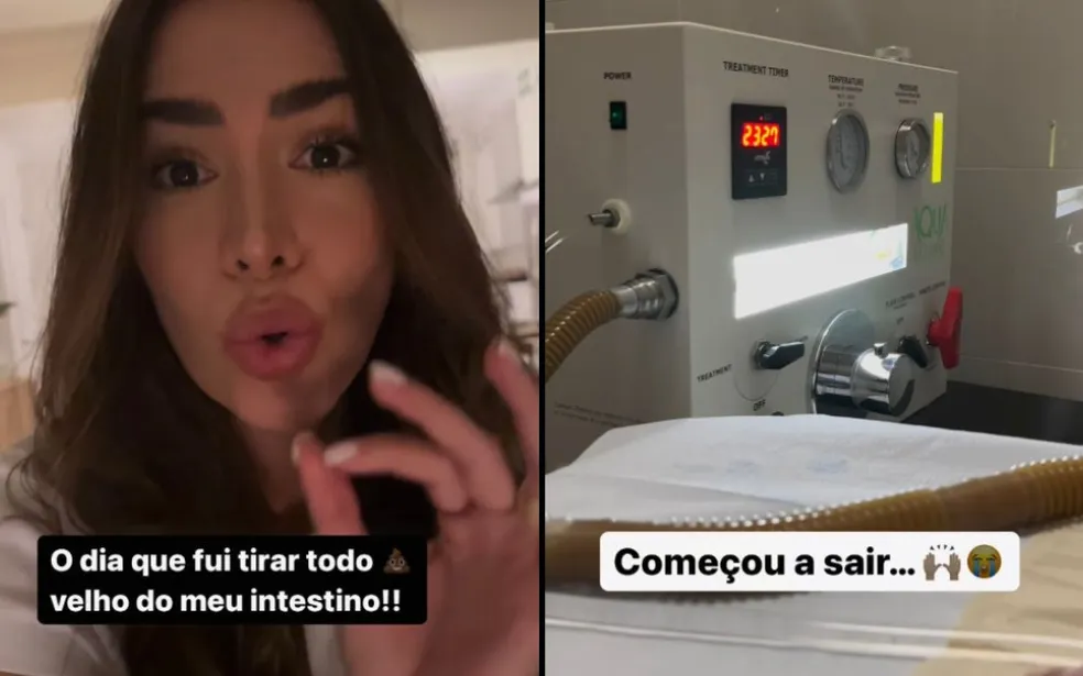 Print do story de Adriana Sant'Anna ao optar por hidrocolonterapia para alívio abdominal