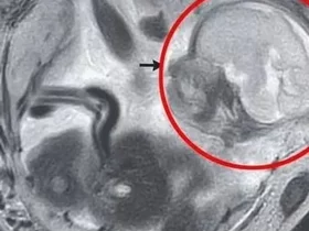 Mulher descobre gestação ectópica próxima de órgãos vitais