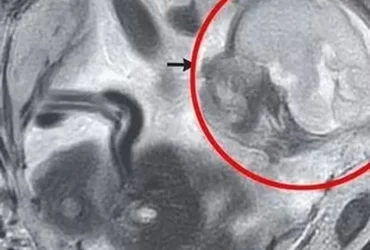 Mulher descobre gestação ectópica próxima de órgãos vitais