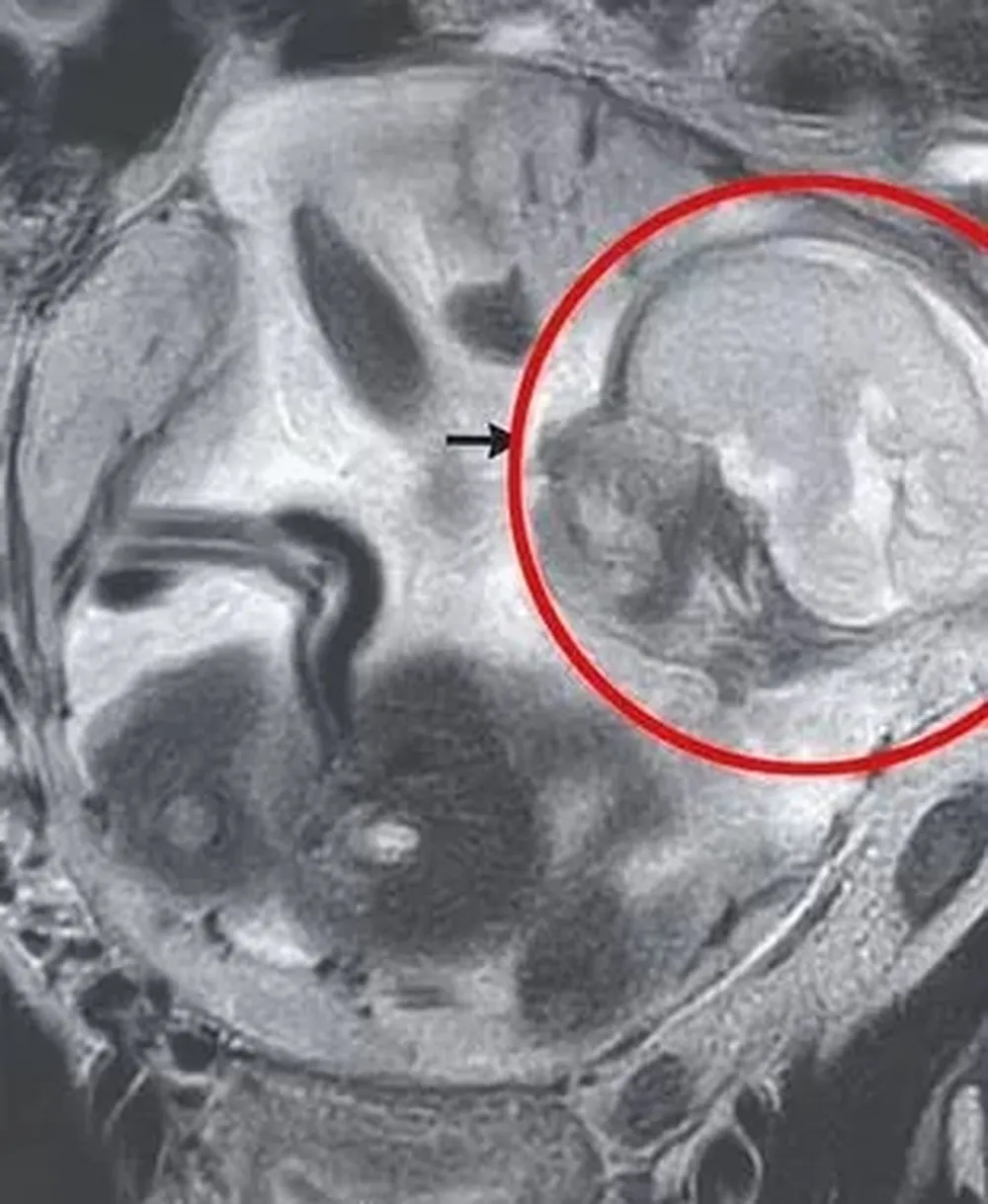 Mulher descobre gestação ectópica próxima de órgãos vitais