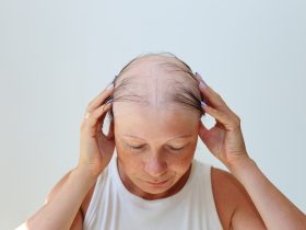 Perda de cabelo na forma de alopecia areata. Por nadzeyakolabava