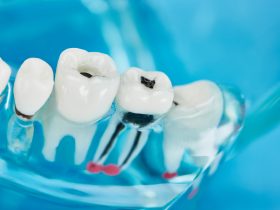 modelo de foco seletivo de dentes com cárie dentária em dentes brancos sobre azul Por LightFieldStudios