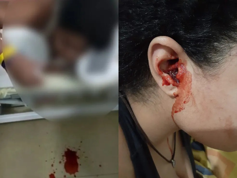 Ouvido da jovem de 19 anos sangrando