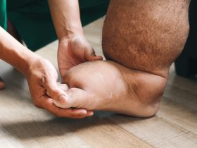 Vista de perto: Doutor Hand examinando a filariose do pé Por Queenmoonlite35