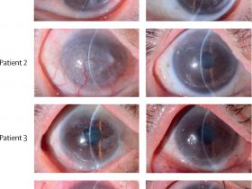 Imagem do antes e depois do olho de um dos pacientes que teve a visão restaurada na pesquisa Foto: artigo científico publicado no The Lancet